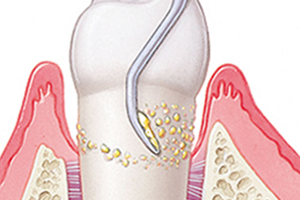 中程度の歯周病